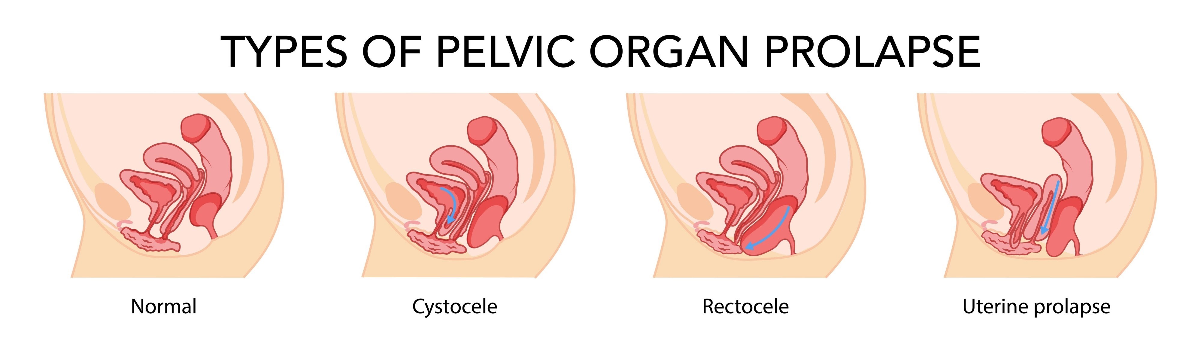 Pelvic Organ